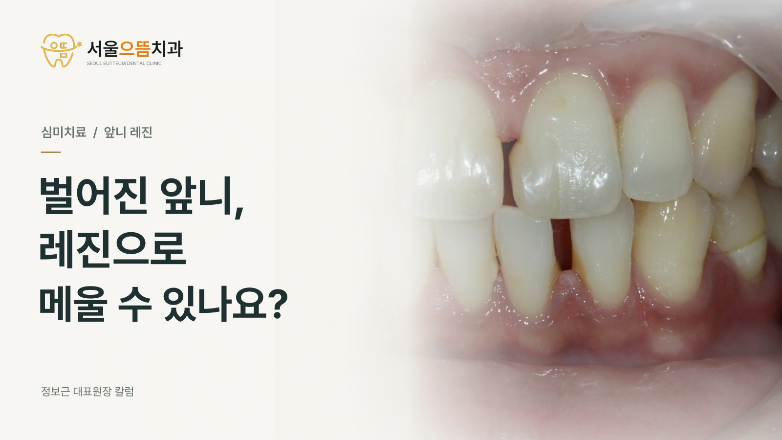 서울으뜸치과 로고와 벌어진 앞니를 레진으로 메울 수 있는지 묻는 제목이 왼쪽에 있고, 실제 초진 구강 사진이 오른쪽 배경으로 부드럽게 이어지는 썸네일