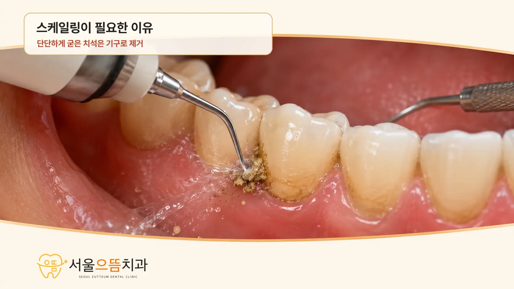 초음파 스케일러와 수기구를 이용한 단단한 치석 제거 아래 어금니 잇몸선에 단단하게 붙은 치석을 초음파 스케일러의 진동과 물로 분리하고 수기구로 남은 부위를 확인하는 실사형 이미지