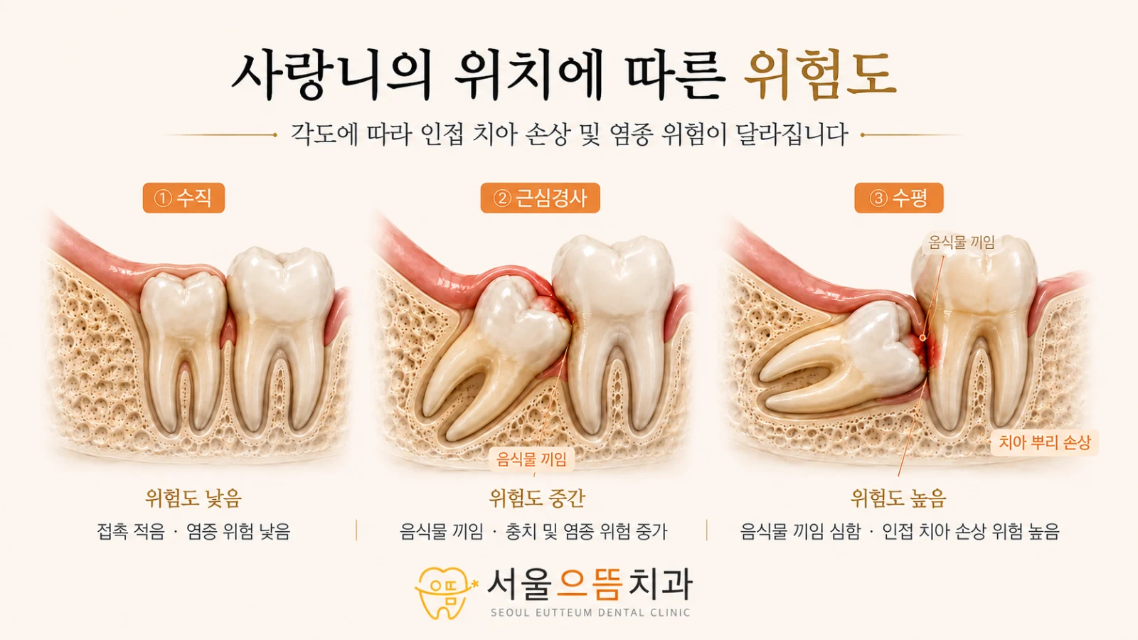 수직·근심경사·수평 사랑니의 방향과 앞 어금니 접촉 위치, 청결 가능성을 비교한 도해