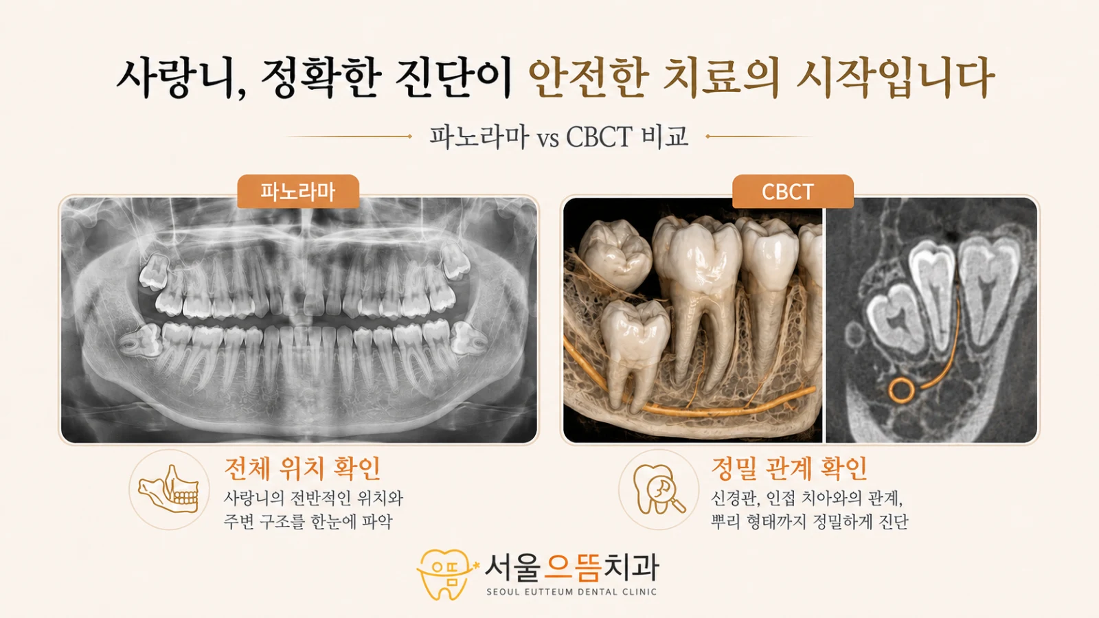 파노라마로 사랑니의 방향과 주변 구조를 먼저 확인하고 필요 시 CBCT로 치근흡수와 신경관 관계를 정밀 평가하는 과정을 설명한 도해