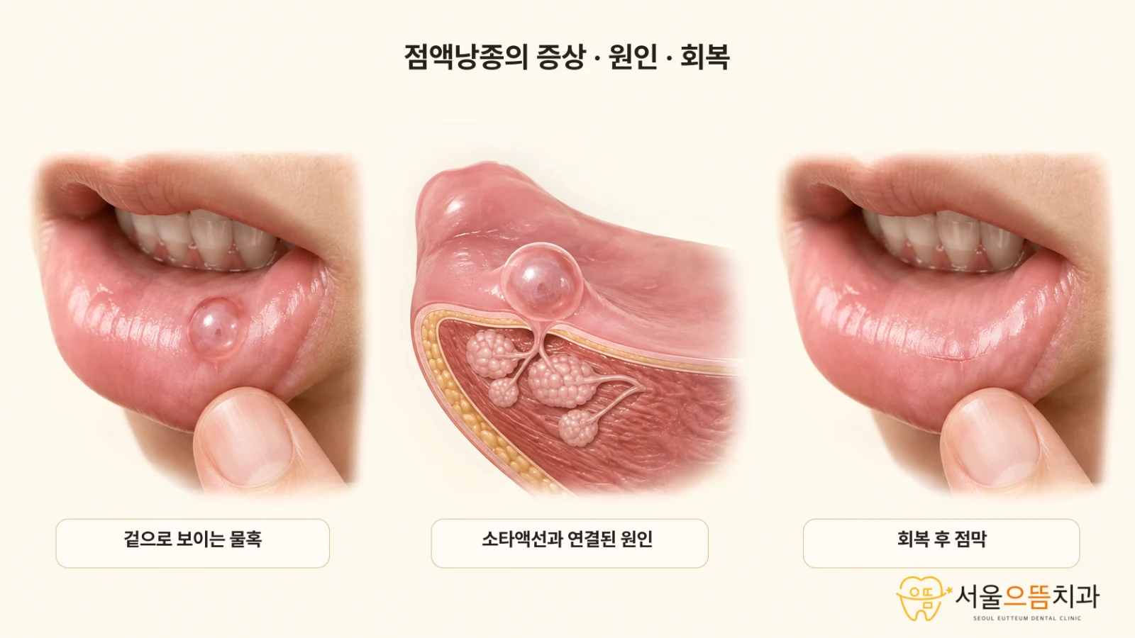 점액낭종의 증상·발생 원인·회복 과정 아랫입술 점액낭종의 겉모습, 소타액선과 연결된 내부 구조, 치료 후 매끈하게 회복된 점막을 왼쪽부터 보여주는 실사형 3단계 도해