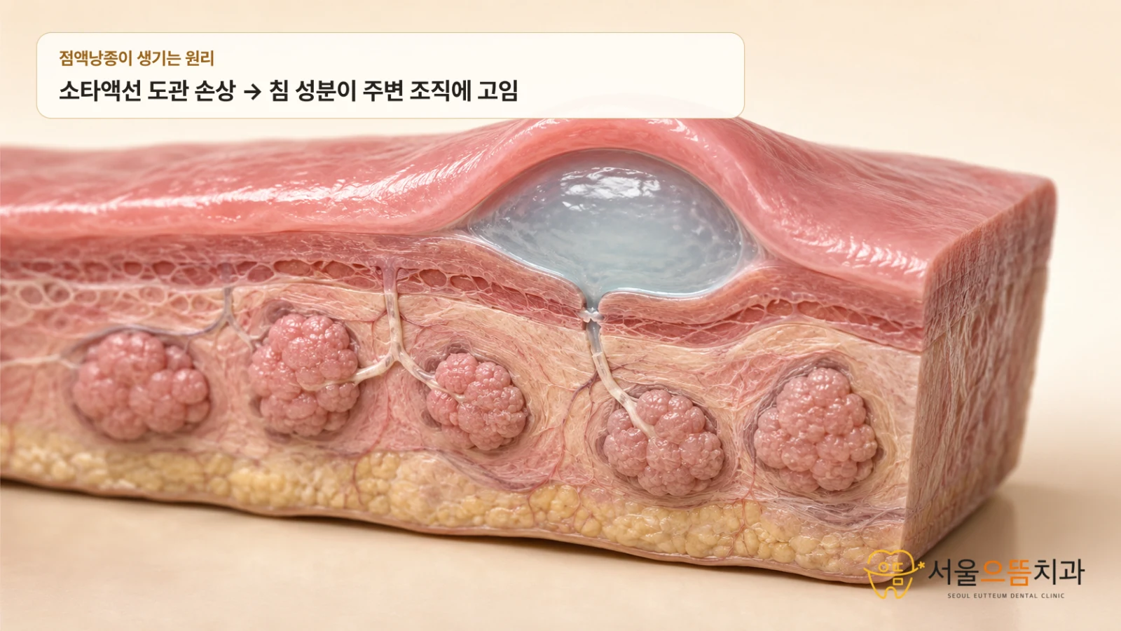 소타액선 도관 손상과 점액낭종 형성 과정 아랫입술 단면에서 소타액선 도관이 손상된 뒤 침 성분이 주변 조직에 고여 표면이 둥글게 부풀어 오르는 과정을 보여주는 실사형 3D 해부 도해