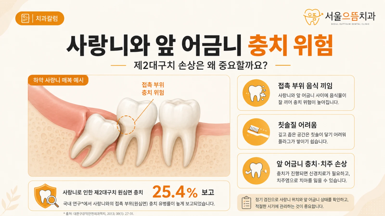 사랑니와 앞 어금니 충치 위험 매복 하악 사랑니와 인접 제2대구치 원심면 충치 25.4% 및 위험이 증가하는 접촉 조건을 설명한 도해