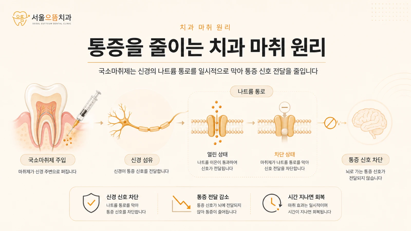 치과 국소마취제가 신경의 나트륨 통로를 차단해 통증 신호 전달을 줄이는 원리를 설명한 도해