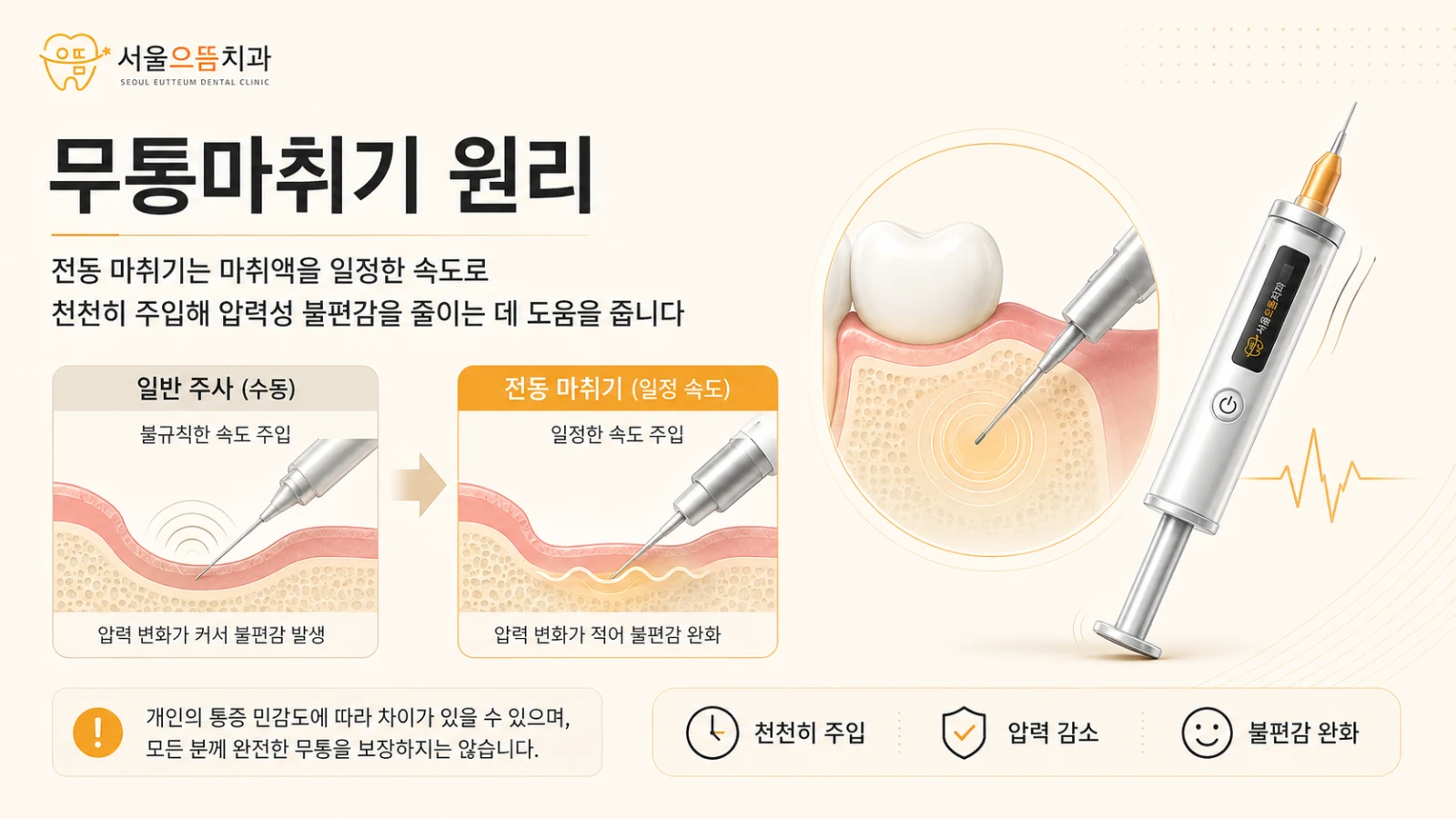 일반 수동 주사와 전동 마취기의 주입 속도와 압력 차이를 비교해 통증 저감 원리를 설명한 도해
