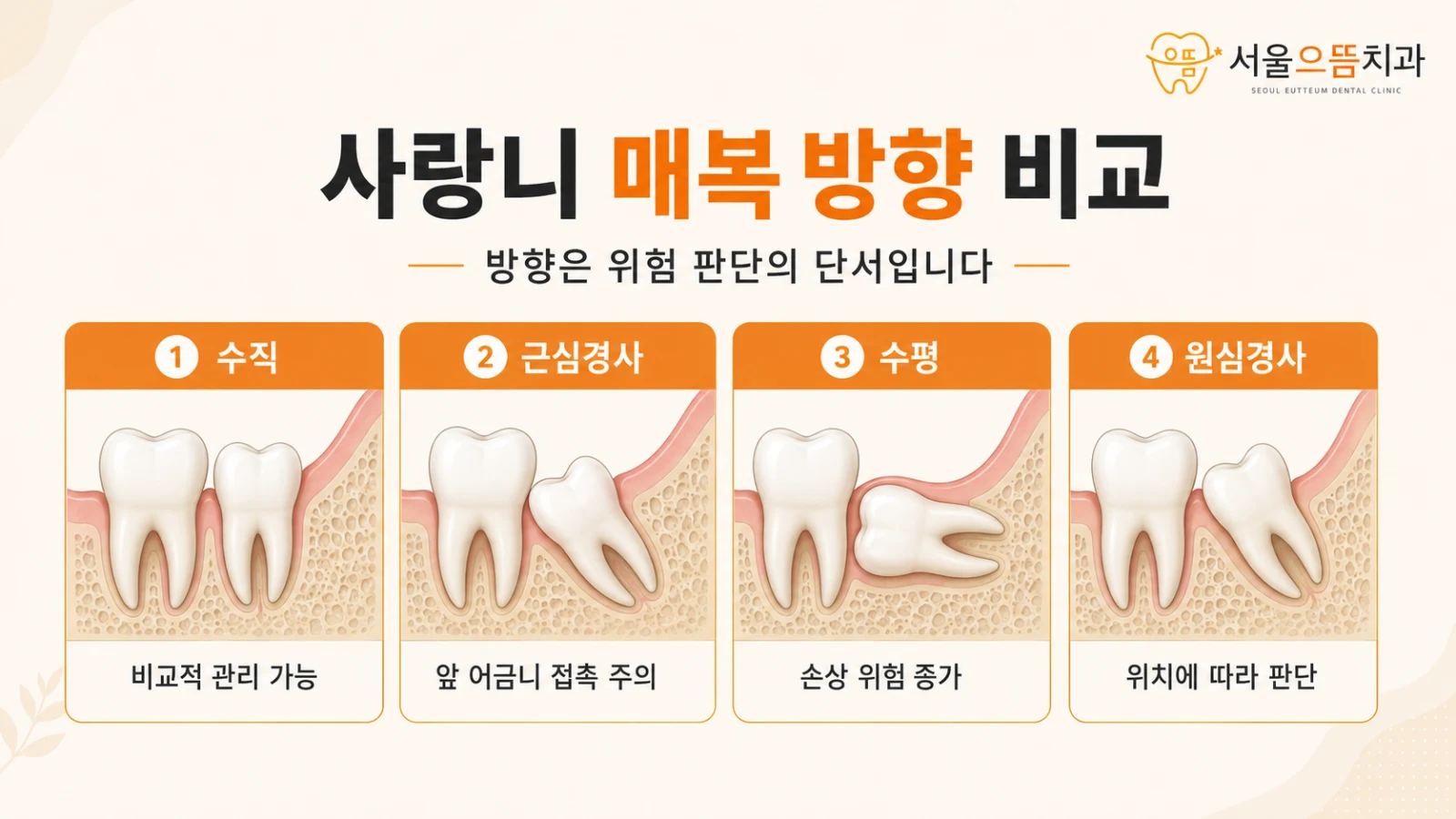 사랑니 매복 방향 비교 수직·근심경사·수평·원심경사 사랑니의 방향과 주변 치아에 미치는 영향을 비교한 도해