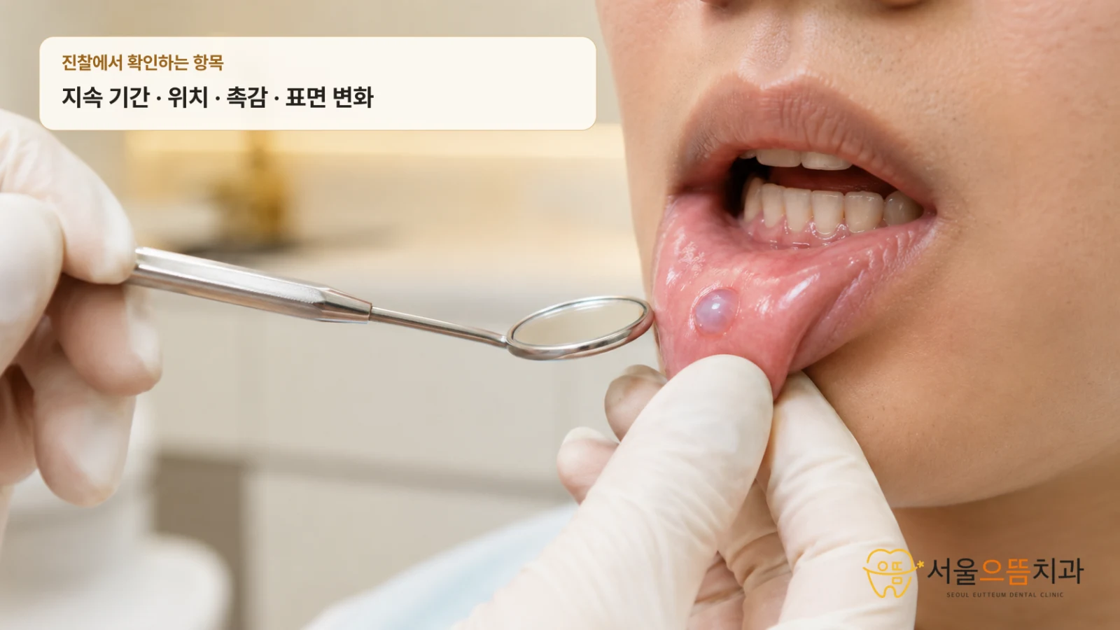 아랫입술 안쪽 점액낭종의 임상 진찰 치과에서 아랫입술 안쪽의 작고 투명한 청분홍색 물혹을 관찰하며 점액낭종 가능성을 확인하는 실사형 진찰 장면