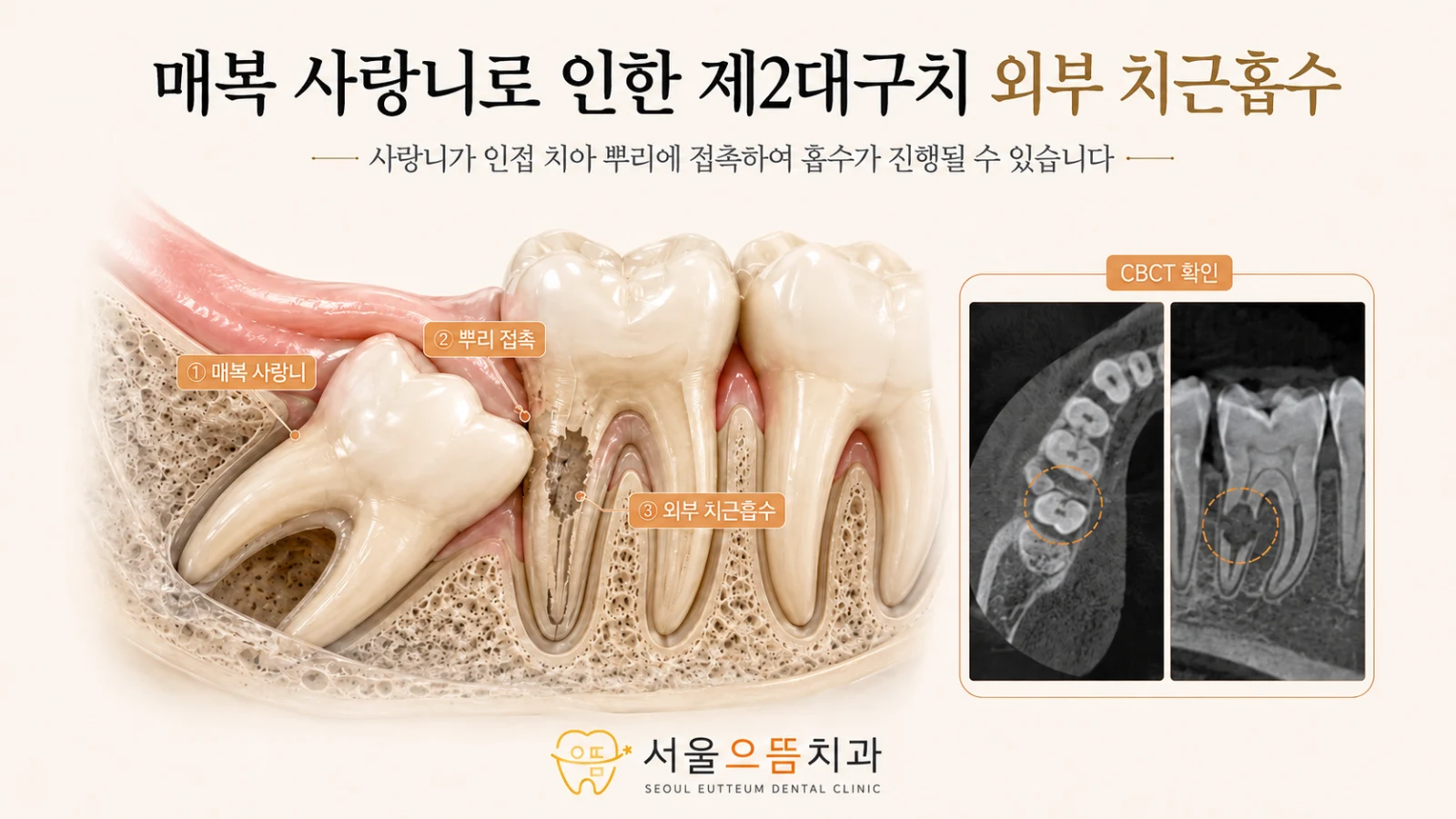 매복 사랑니와 인접 제2대구치 뿌리의 밀착 부위에서 발생할 수 있는 외부 치근흡수를 설명한 CBCT형 도해