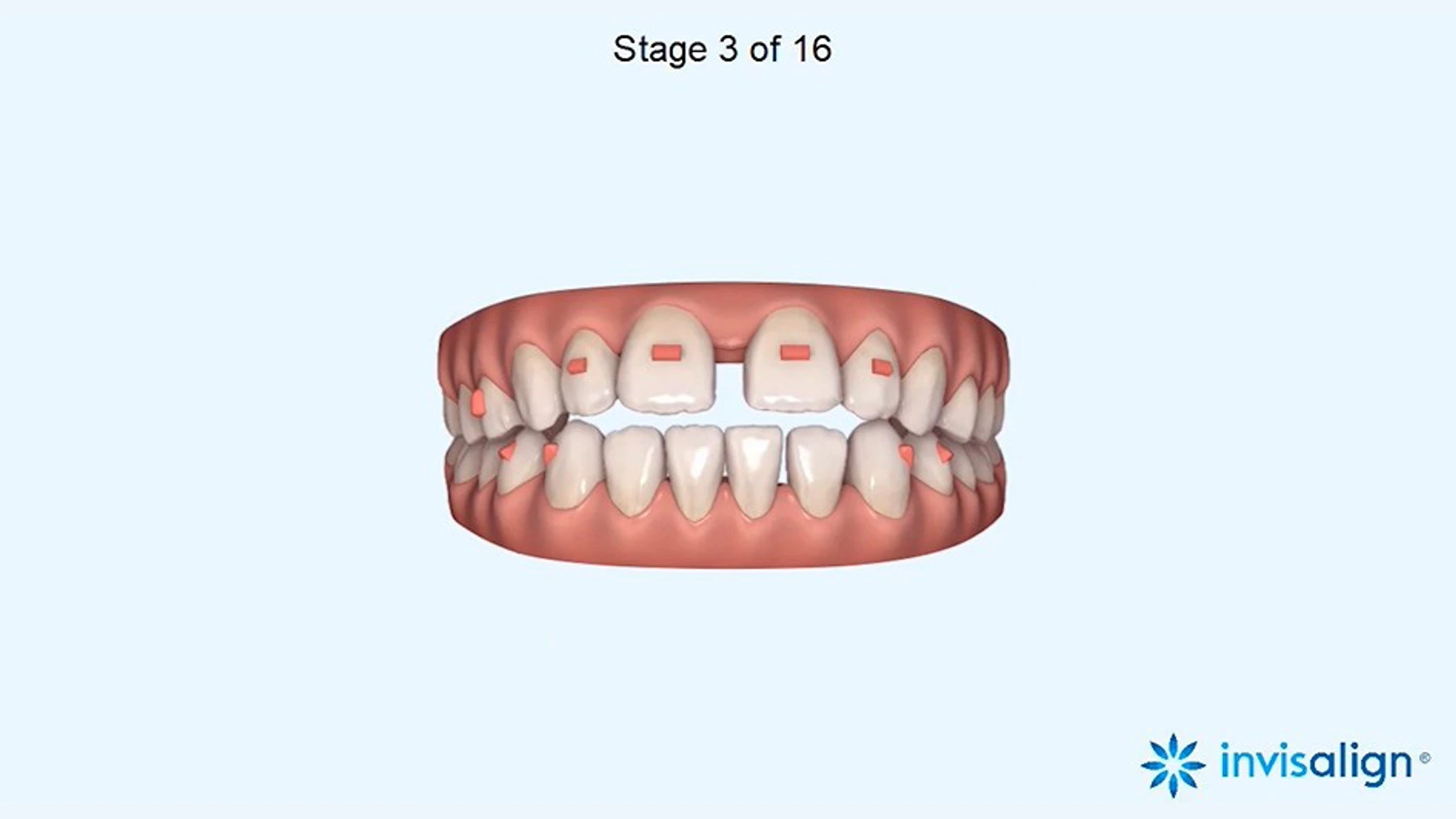 인비절라인 클린체크에서 16단계 중 3단계 치아 배열과 어태치먼트 위치를 보여주는 실제 3차원 치료계획 예시 화면