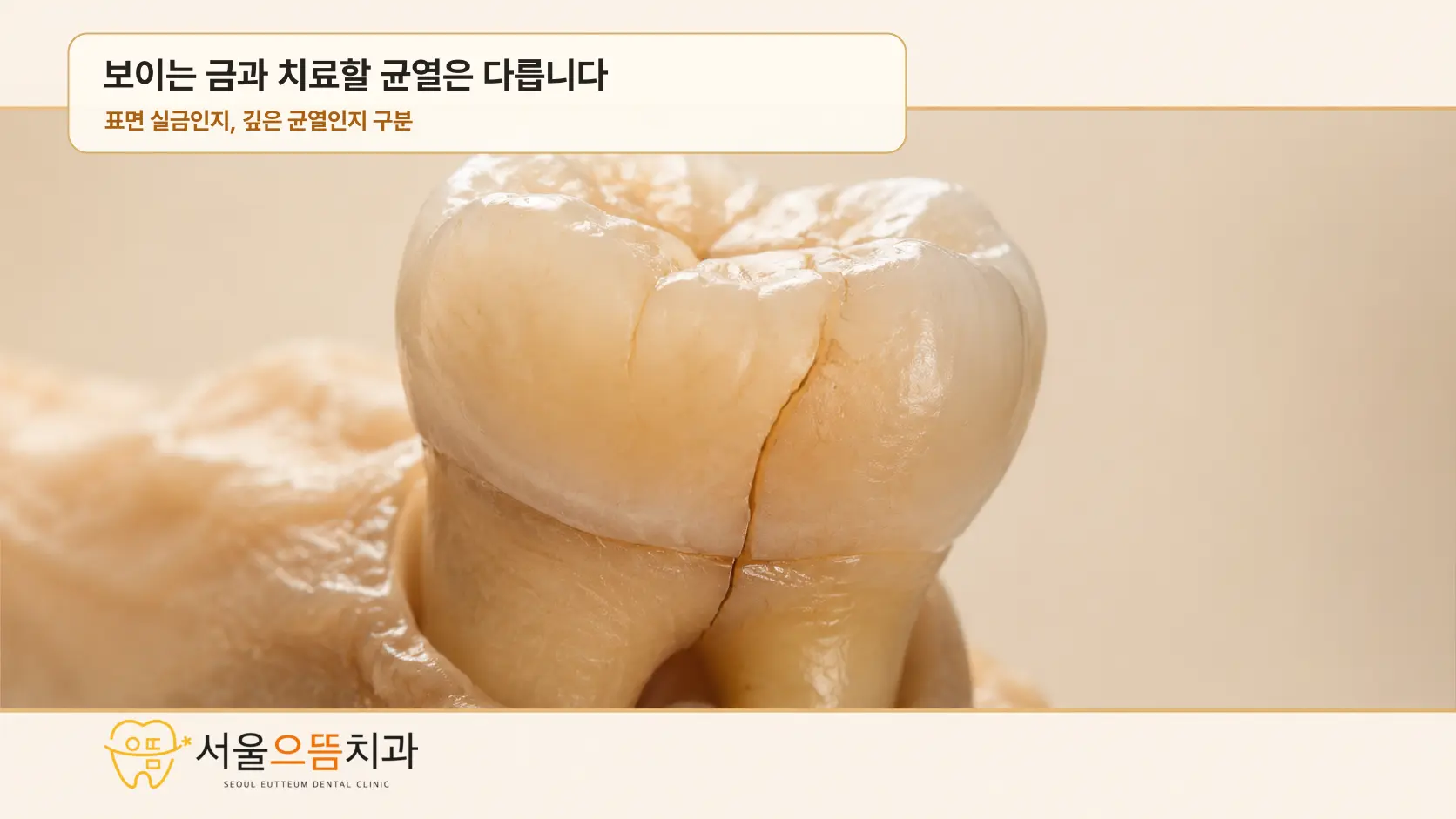 치아 겉면에만 있는 가는 실금과 치아 안쪽으로 이어진 깊은 균열을 비교한 실사형 어금니 모형