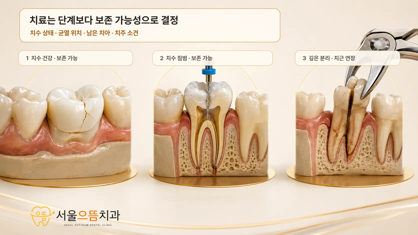 관찰과 수복이 가능한 치아, 신경치료와 크라운이 필요한 치아, 깊게 나뉘어 발치를 검토하는 치아를 비교한 실사형 모형