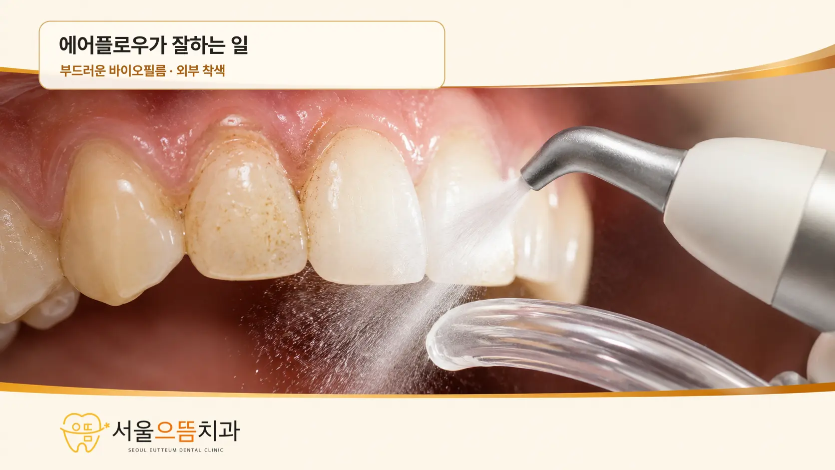 치태 확인부터 에어플로우와 선택적 치석 제거까지의 병행 과정 치면착색제로 치태 분포를 확인한 뒤 에어플로우로 바이오필름과 착색을 제거하고 남은 단단한 치석만 초음파 기구로 선택 제거하는 세 단계 실사형 진료 과정