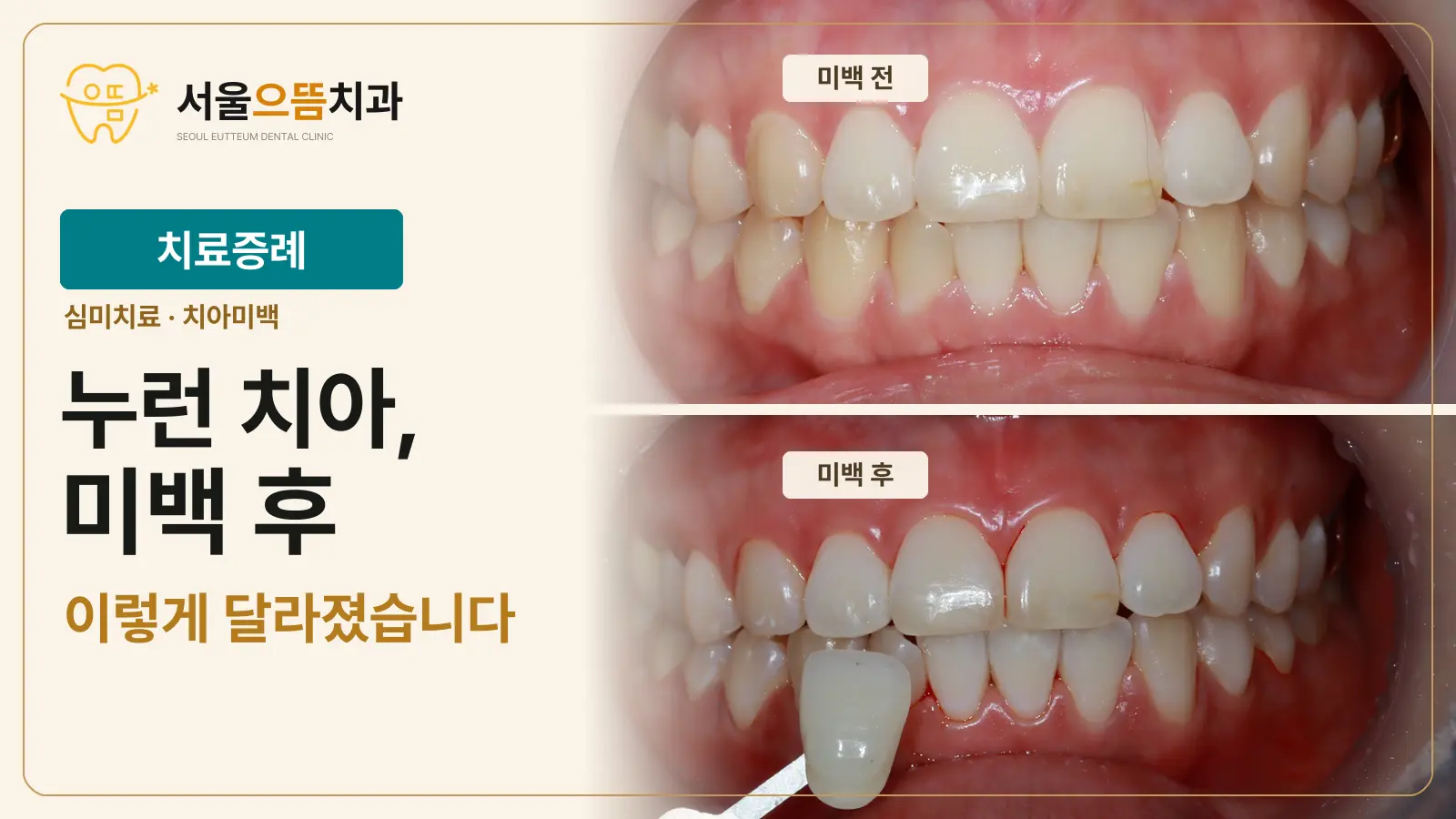 서울으뜸치과 로고와 치아미백 제목 왼쪽에, 서로 다른 자연 치아색의 색상표 세 개가 오른쪽 배경으로 이어지는 썸네일