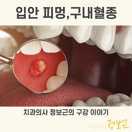 구내염 VS 구내혈종 둘의 차이는?! 썸네일