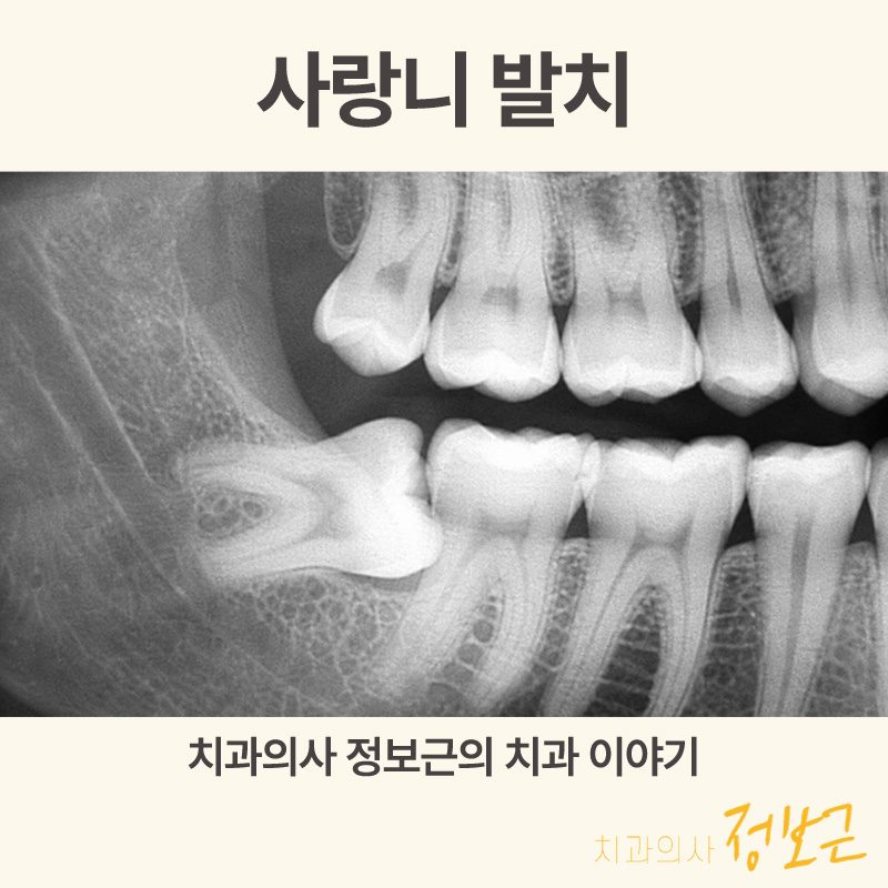 통증 없어도 위험한 사랑니 — 옆 어금니 충치·치근흡수까지 썸네일