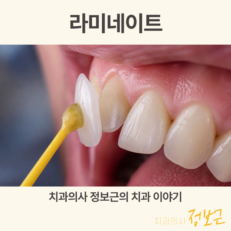 라미네이트 적응증 - 수원 장안동 서울으뜸치과의원