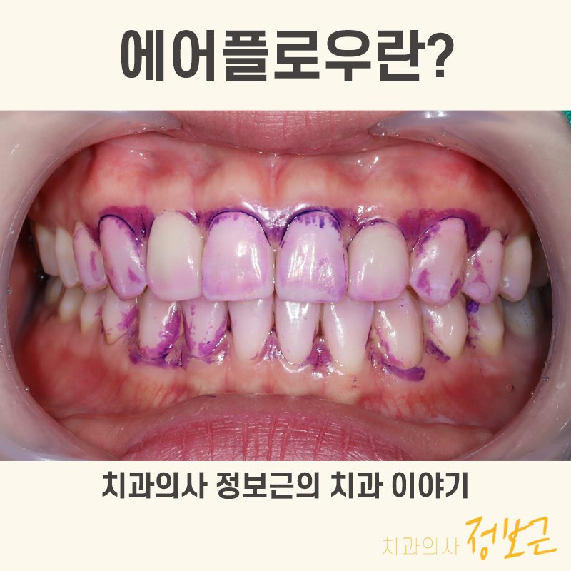에어플로우 안내 - 수원 영화동 서울으뜸치과의원 치과의사 정보근