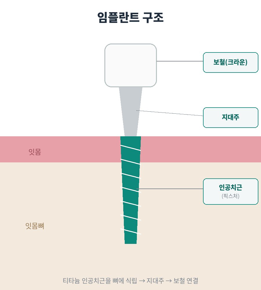 임플란트 구조 모식도(인공치근·지대주·보철)