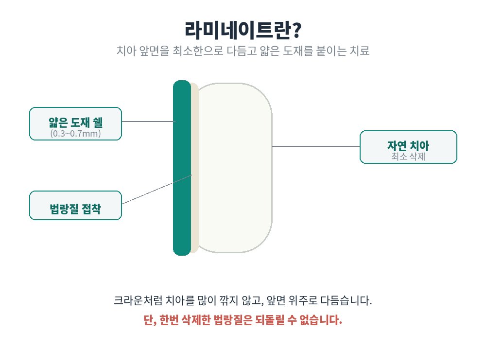 라미네이트 구조 모식도(얇은 도재 쉘과 최소 삭제)