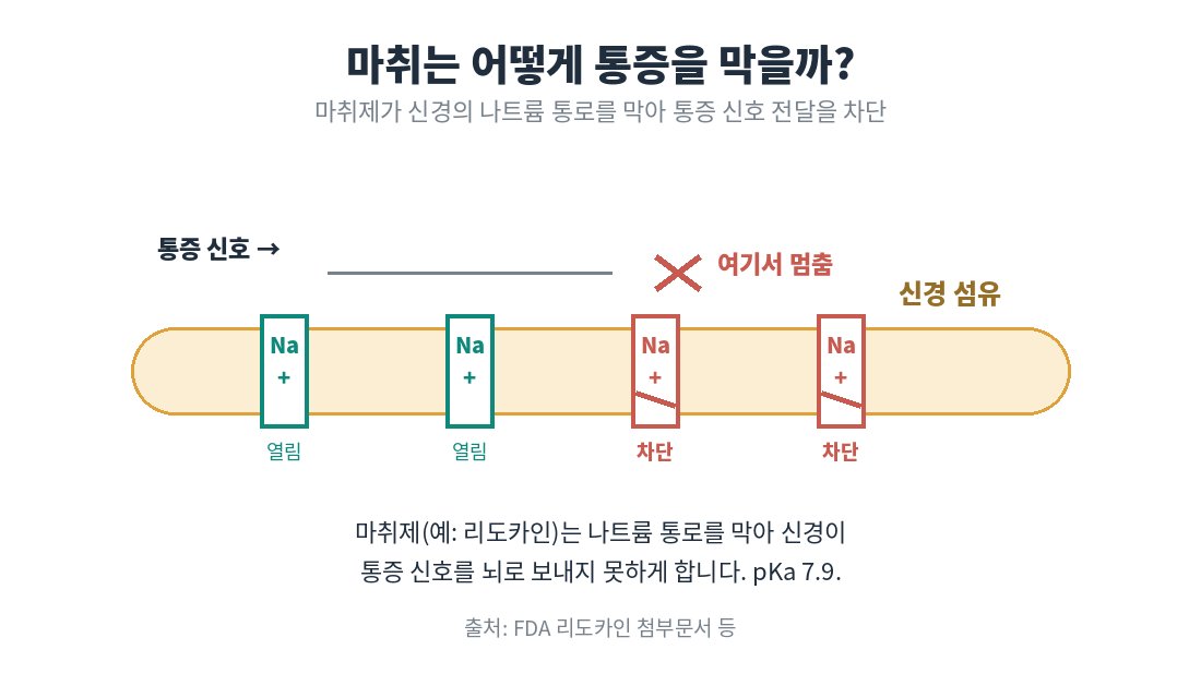 치과 마취 작용 원리 모식도(나트륨 통로 차단으로 통증 신호 차단)