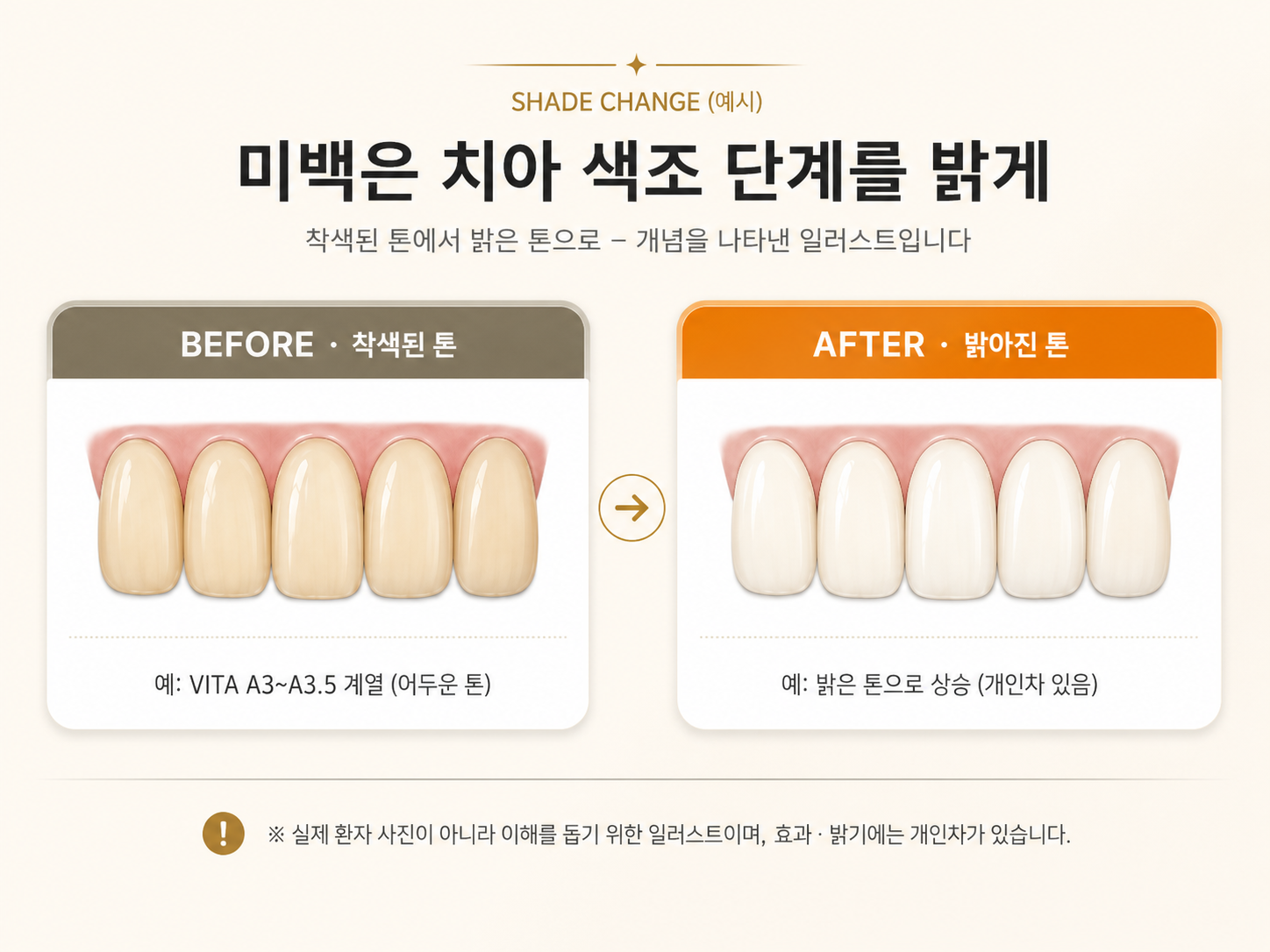 치아미백 전후 색조 변화 예시 - 착색된 치아가 밝은 톤으로 변화하는 과정을 비교한 인포그래픽