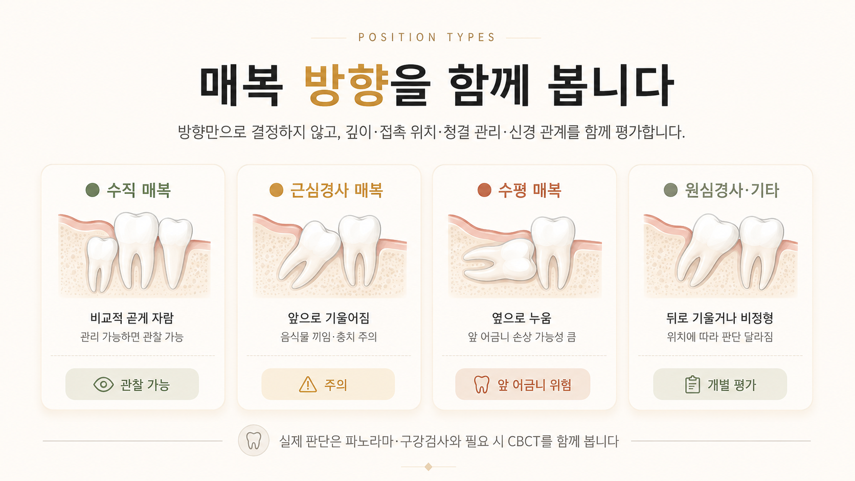 수직·근심경사·수평·원심경사 사랑니의 위치와 앞 어금니 손상 가능성을 비교한 인포그래픽