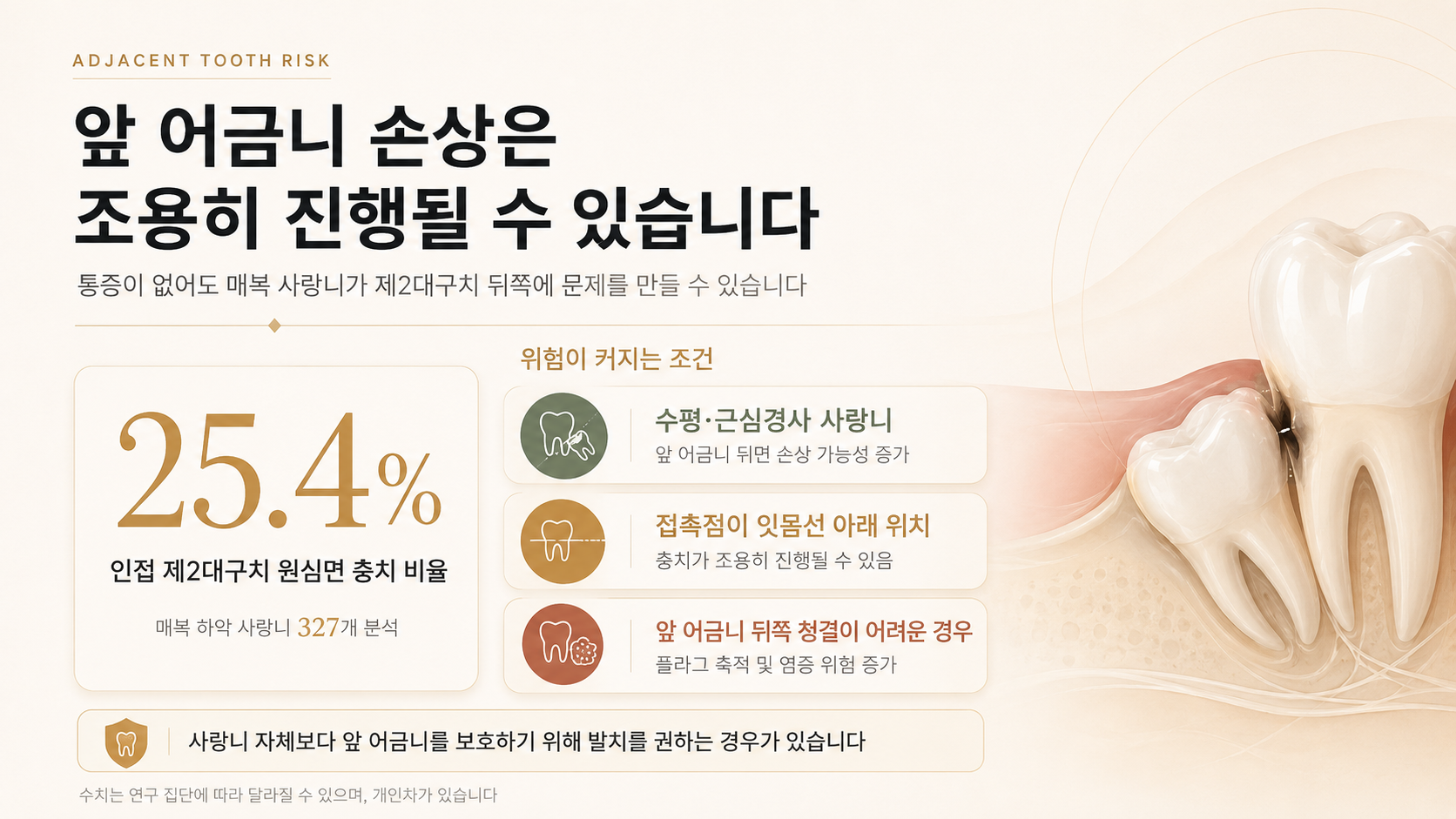매복 하악 사랑니에 인접한 제2대구치 원심면 충치 25.4%와 위험이 증가하는 조건을 설명한 인포그래픽
